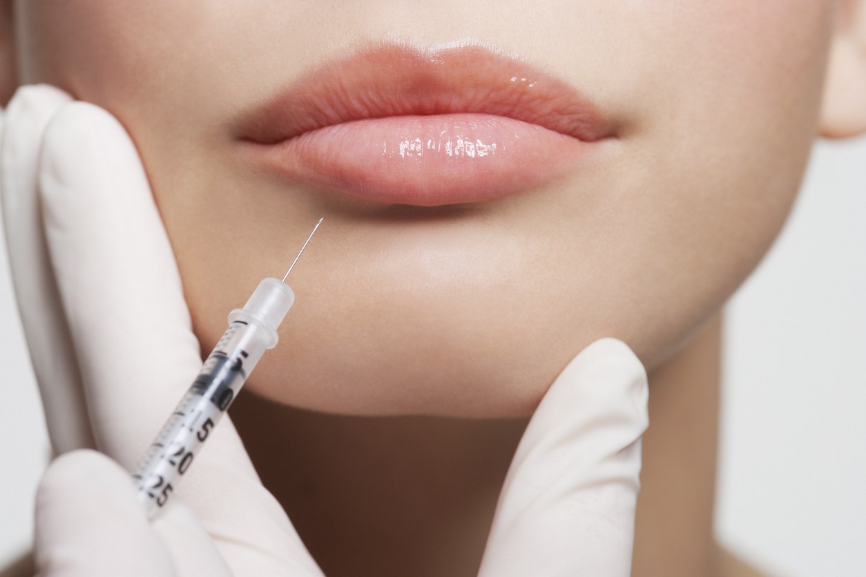 Filler labbra eseguito dal medico estetico a Bracciano